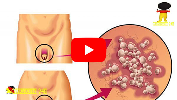 Ulcus molle (Weicher Schanker)